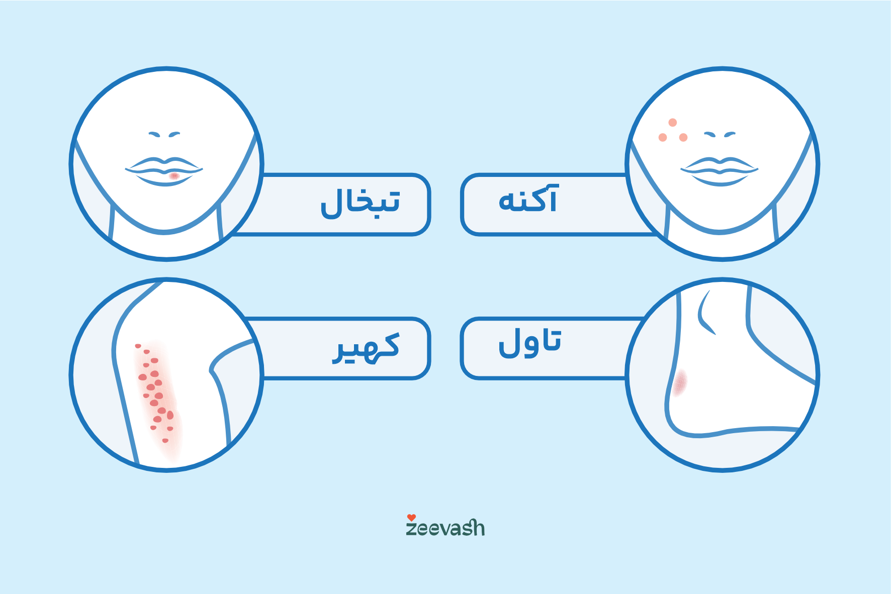 عکس بیماری های پوستی - آکنه تبخال تاول کهیر